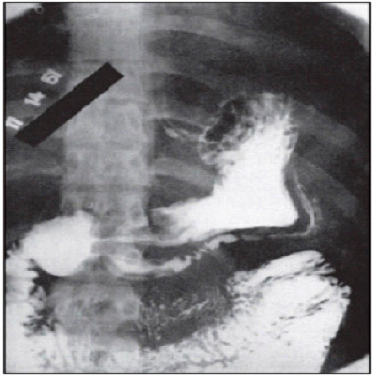 Рентгенография желудка с барием